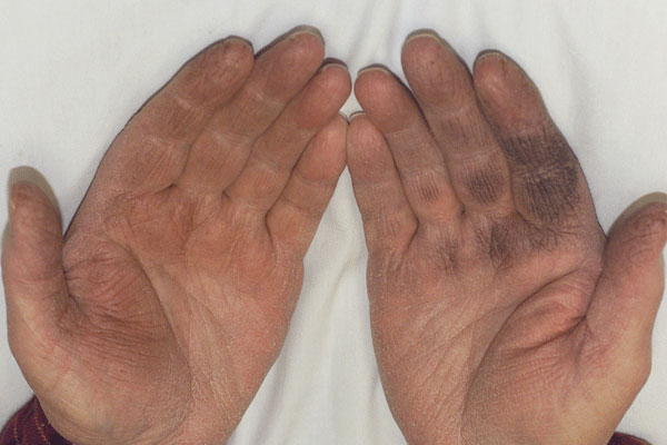 Derm Dx Black Discoloration Of The Hands Healthcare Communications 